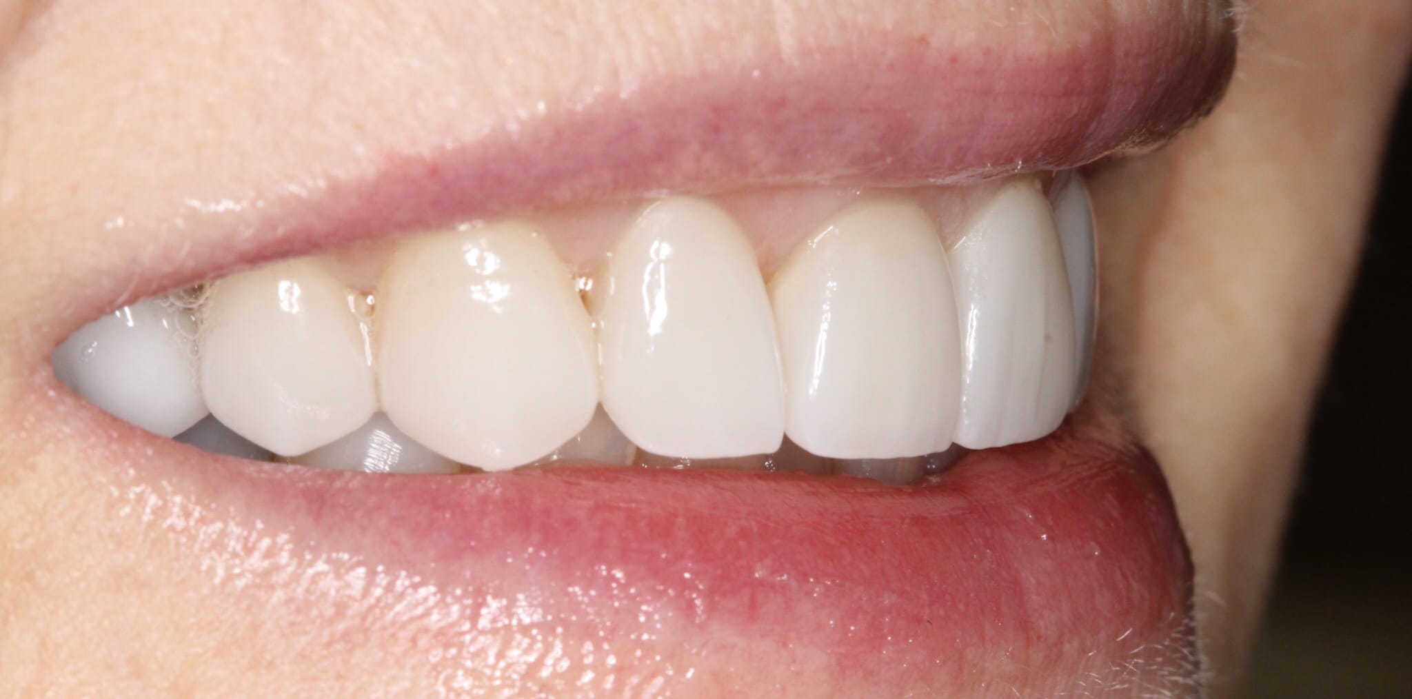 59877 Prepless veneers Featured Image 2 after