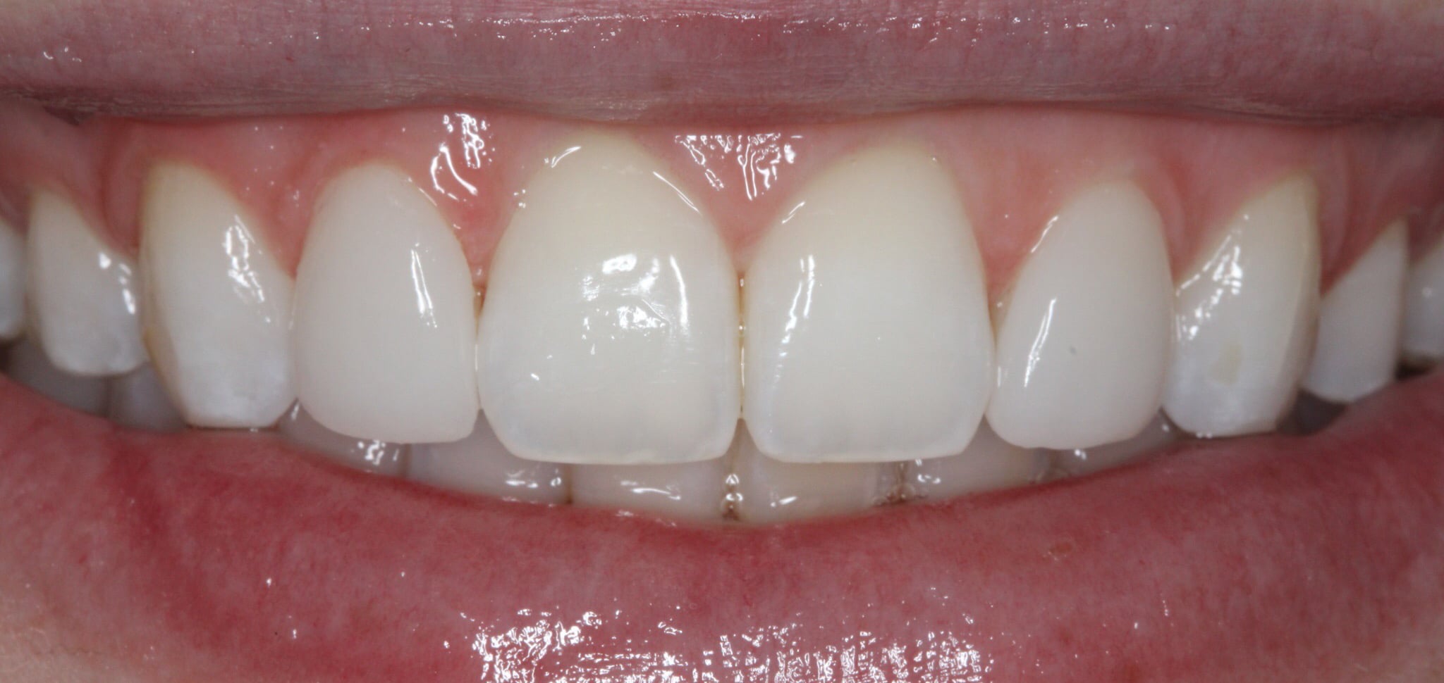 59877 Prepless veneers Featured Image 3 after